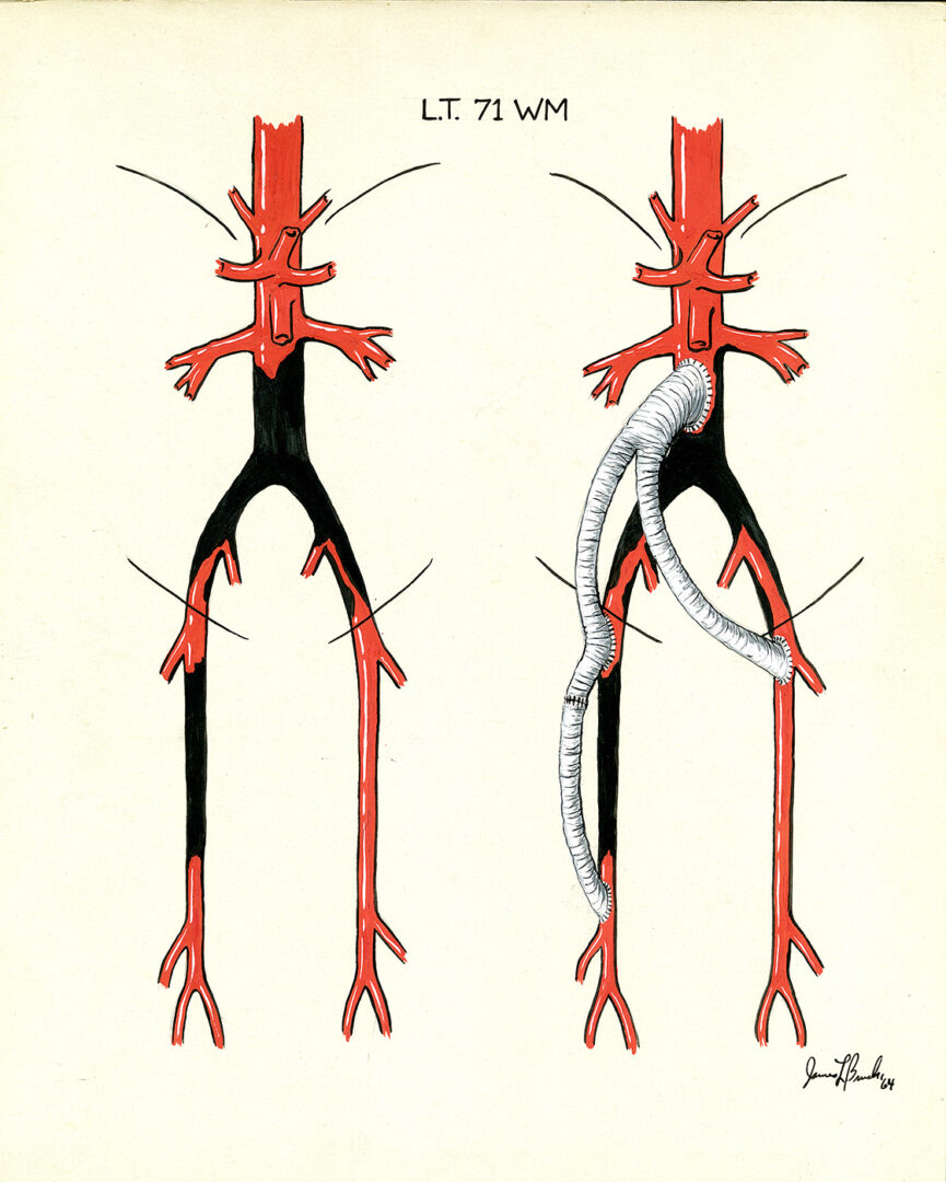Bypass with multi-point aorta graph, 1964